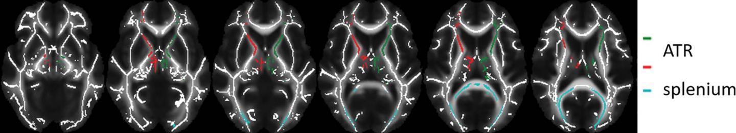 ADHD Medication May Affect Brain Development in Children