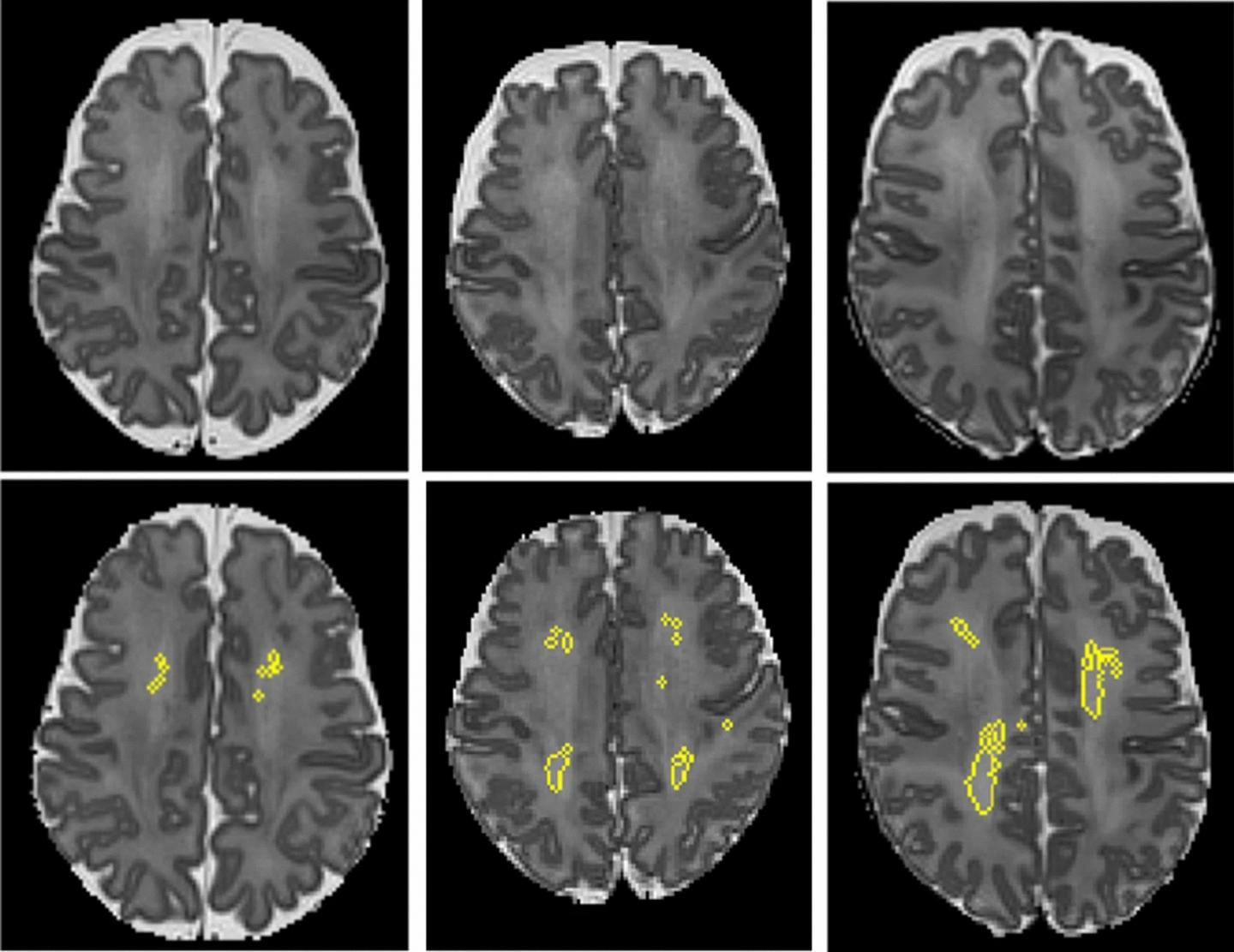 Using MRI to Predict Brain Development Disorders in Preterm Infants