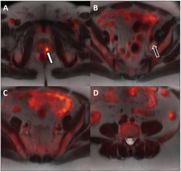 Same patient as above after six weeks of androgen deprivation therapy and decrease in serum prostate specific antigen