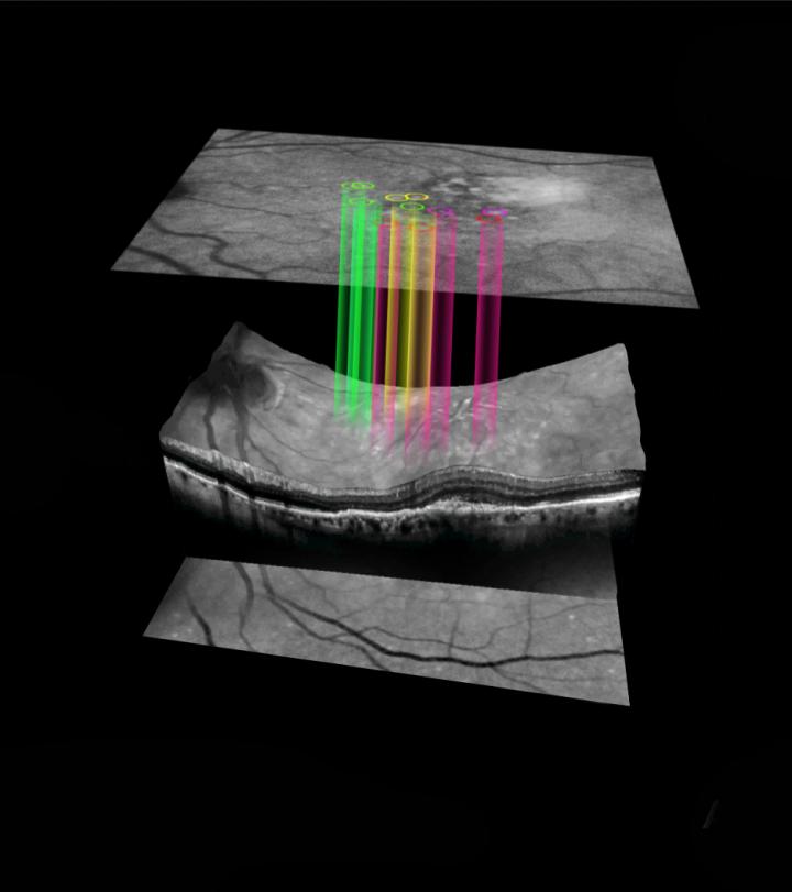 DARC for wet AMD image