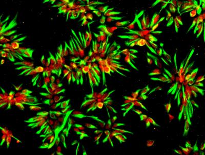 Neural Stem Cells Generated from iPS Cells Derived from a Patient with Alzheimer's Disease