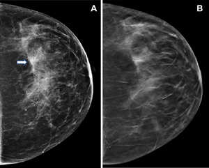 Huge Study Finds Tomosynthesis Better at Breast Cancer Detection