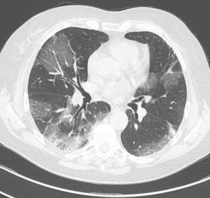 Thorax Tomography