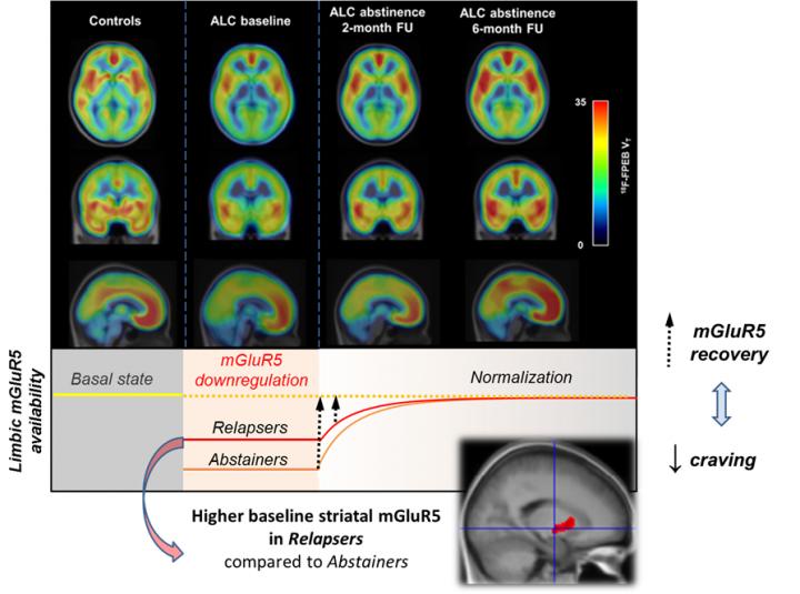 Simplified Model for Alcohol-Induced Changes in Limbic mGluR5 Availability Across the Different Stag