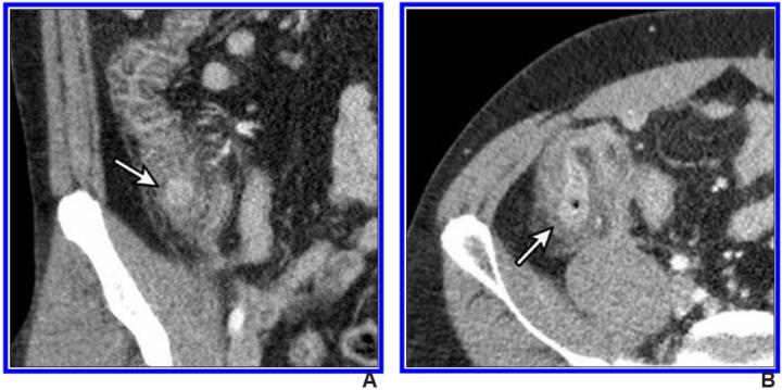 30-Year-Old Man With Right Colonic Diverticulitis