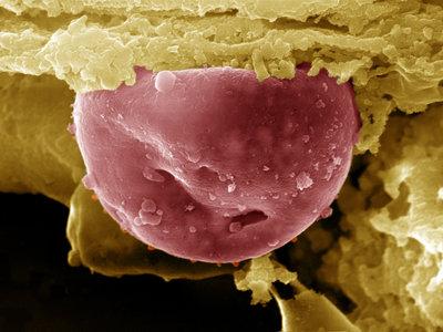 Neutrophil-Derived NETs Make Malaria Worse