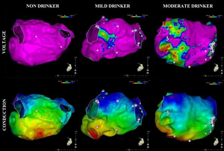 How Much Is Too Much? even Moderate Alcohol Consumption Is a Risk Factor for Atrial Fibrillation