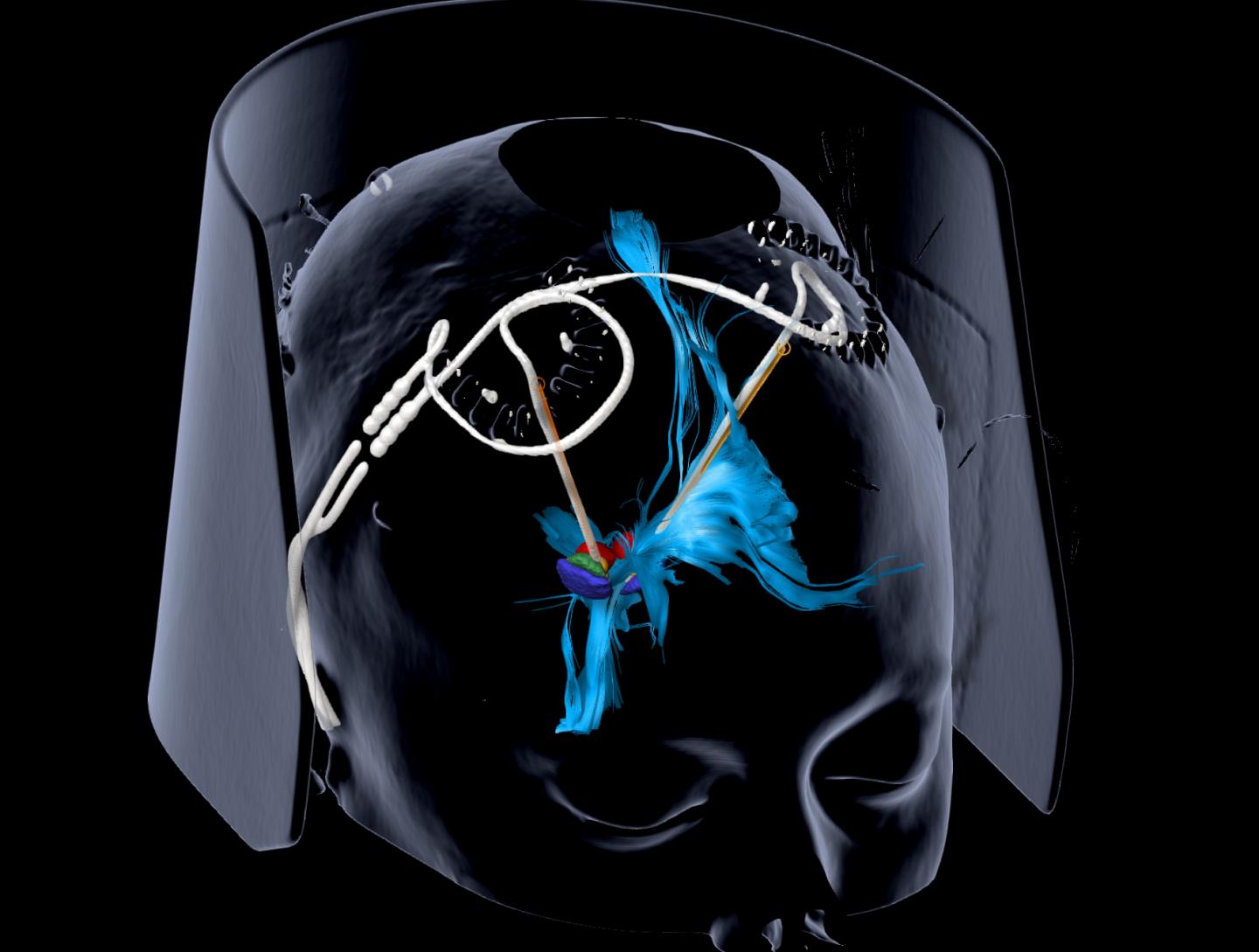 Deep Brain Stimulation Provides Sustained Relief for Severe Depression