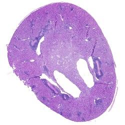 A section through a transplanted kidney shows immune cells infiltrating the tissue