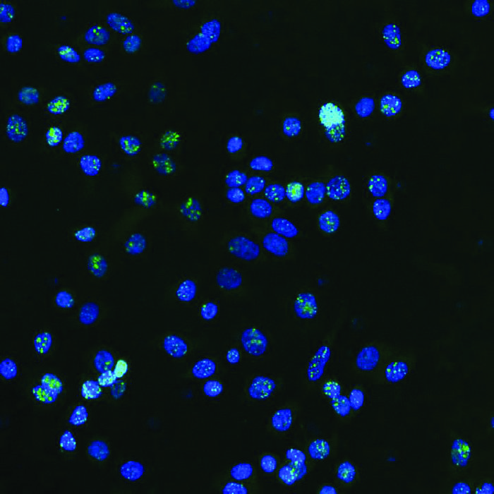 DNA damage in human breast cancer cells