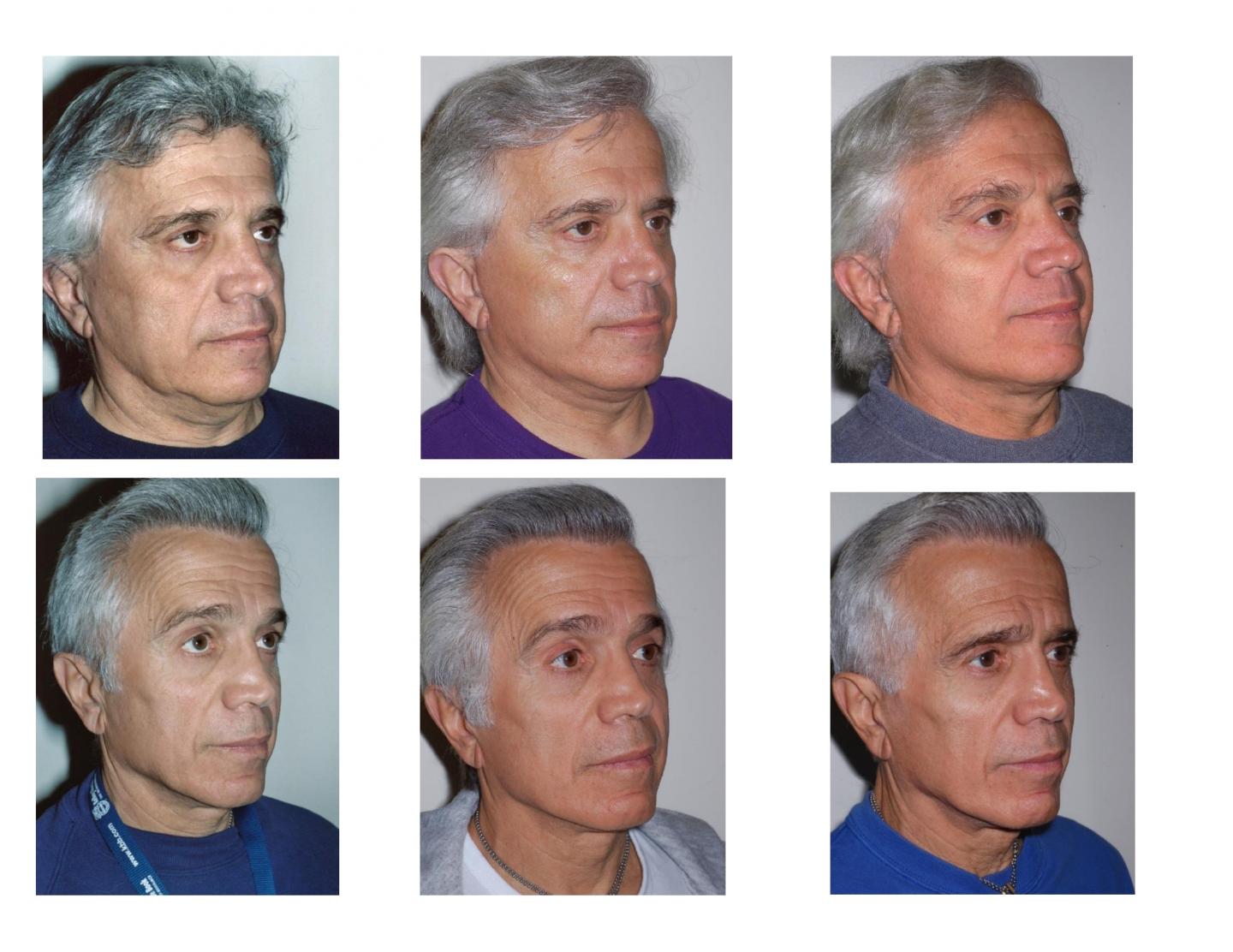 Male Twin Face Lifts -- Pre Op and Post Op