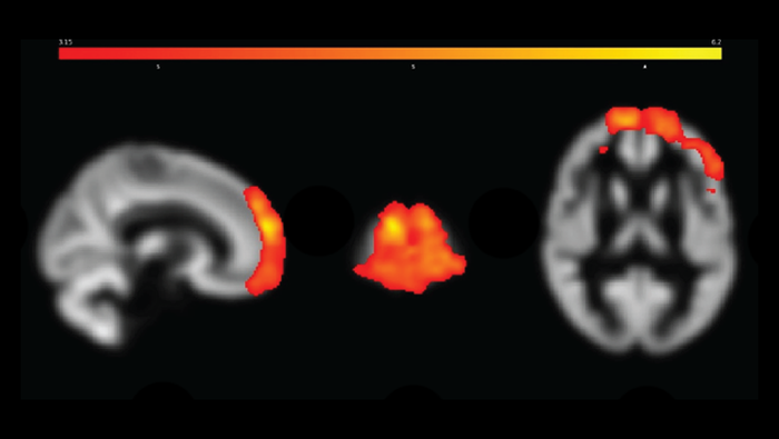 Chronic Pain in Gulf War Veterans Linked to Brain Structure Changes