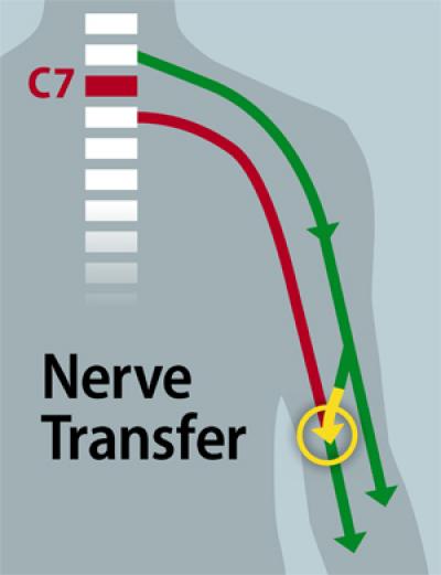 Surgeons Restore Some Hand Function to Quadriplegic Patient (1 of 2)