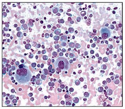 Chronic Myeloid Leukemia Blood Cells