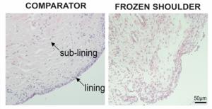 Frozen shoulder tissue sections