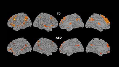 Social Stress: Brain Circuitry Fails To Connect in Children With Autism