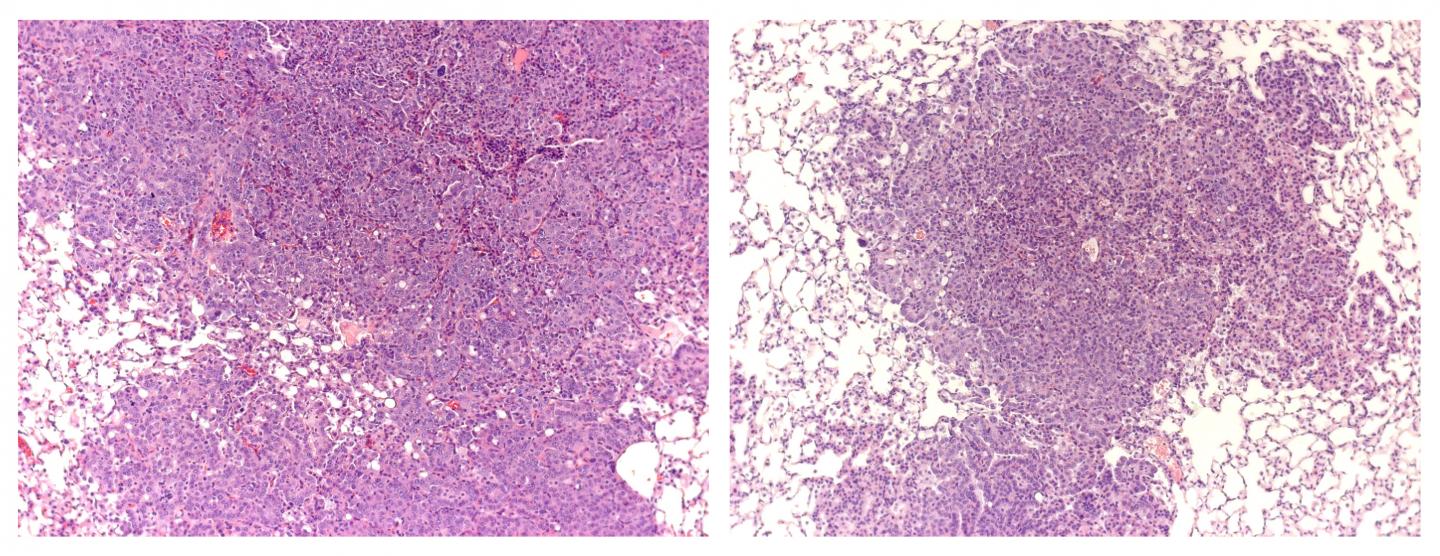 Lung Cancer Treatment