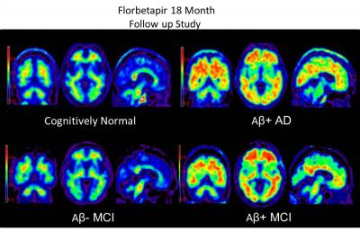 Alzheimer's plaques in PET brain scans identi | EurekAlert!