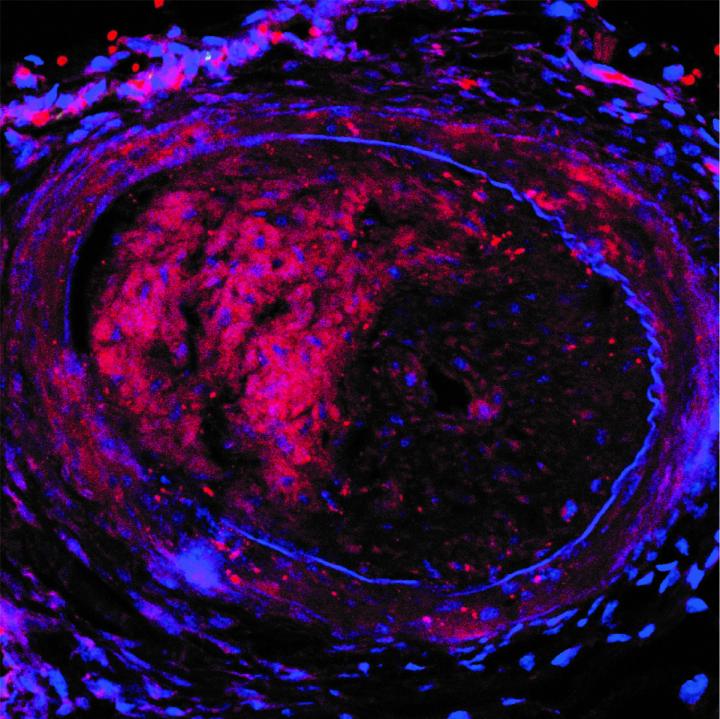 Injured artery with restenosis