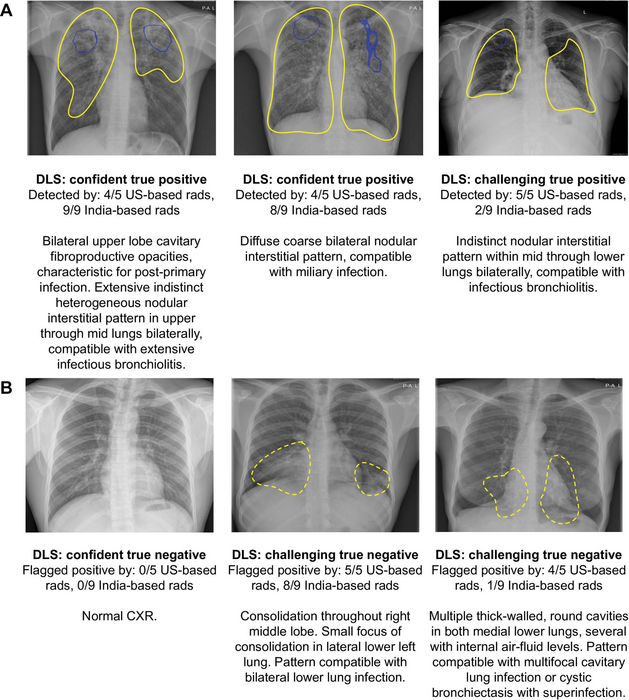 AI-Based System Shows Promise in Tuberculosis Detection