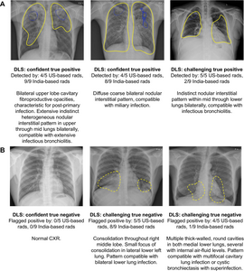 AI-based System Shows Promise in Tuberculosis Detection