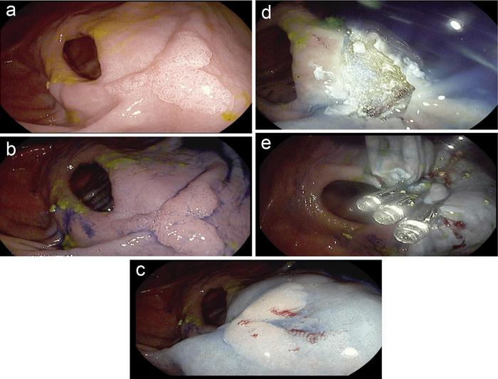 Lateral spreading tumor (LST) with low grade dysplasia resected with “en bloc” EMR in a patient with longstanding CD with ileocecal resection and left hemicolectomy for adenocarcinoma