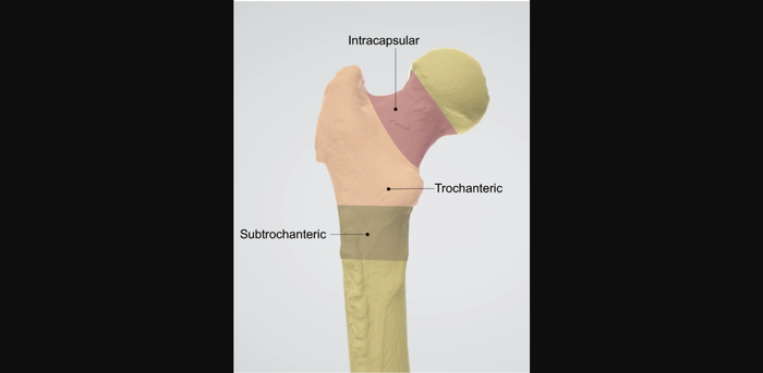 Hip fracture classes