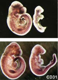 Cancer Gene Drives Vascular Disorder (2 of 2)