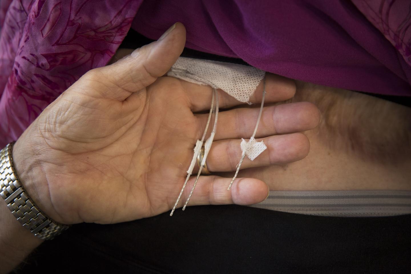 Spinal Leads Exit the Back to Connect to an External Stimulator