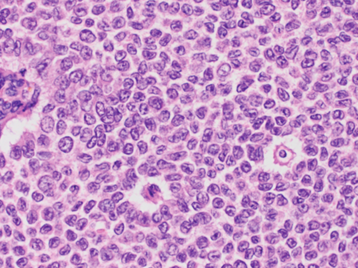 Image of an ovarian granulosa cell tumor