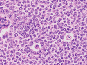 Image of an ovarian granulosa cell tumor