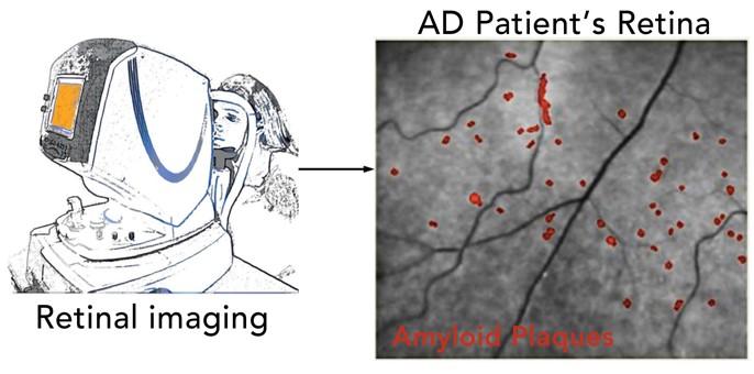 Retinal Imaging for Early Detection of Alzheimer's Disease