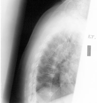 Osteoporosis X-Ray