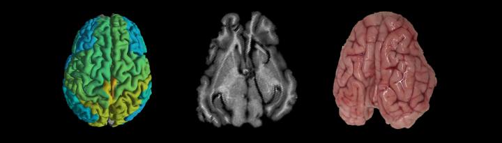 MRI Scan Shows Differences in Molecular Makeup in Different Parts of the Brain