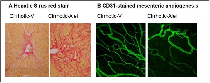 Researchers Find a Promising New Approach for Treating Liver Cirrhosis