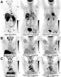 68Ga-ABY-025 PET/CT and 18F-FDG PET/CT images at baseline with 18F-FDG PET/CT follow-up after 2 cycles of treatment in biopsy-confirmed HER2-positive disease.