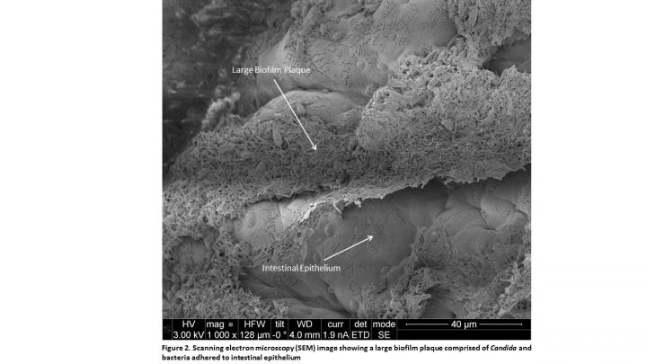 Antifungals and Probiotics May Play a Key Role in the Development of Treatment for Crohn's Disease