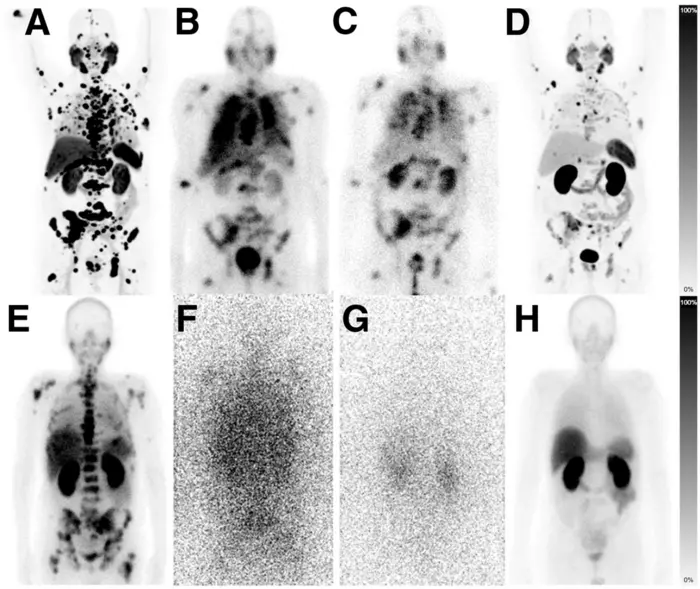 Lower dose prostate cancer treatments retain efficacy while improving tolerability.