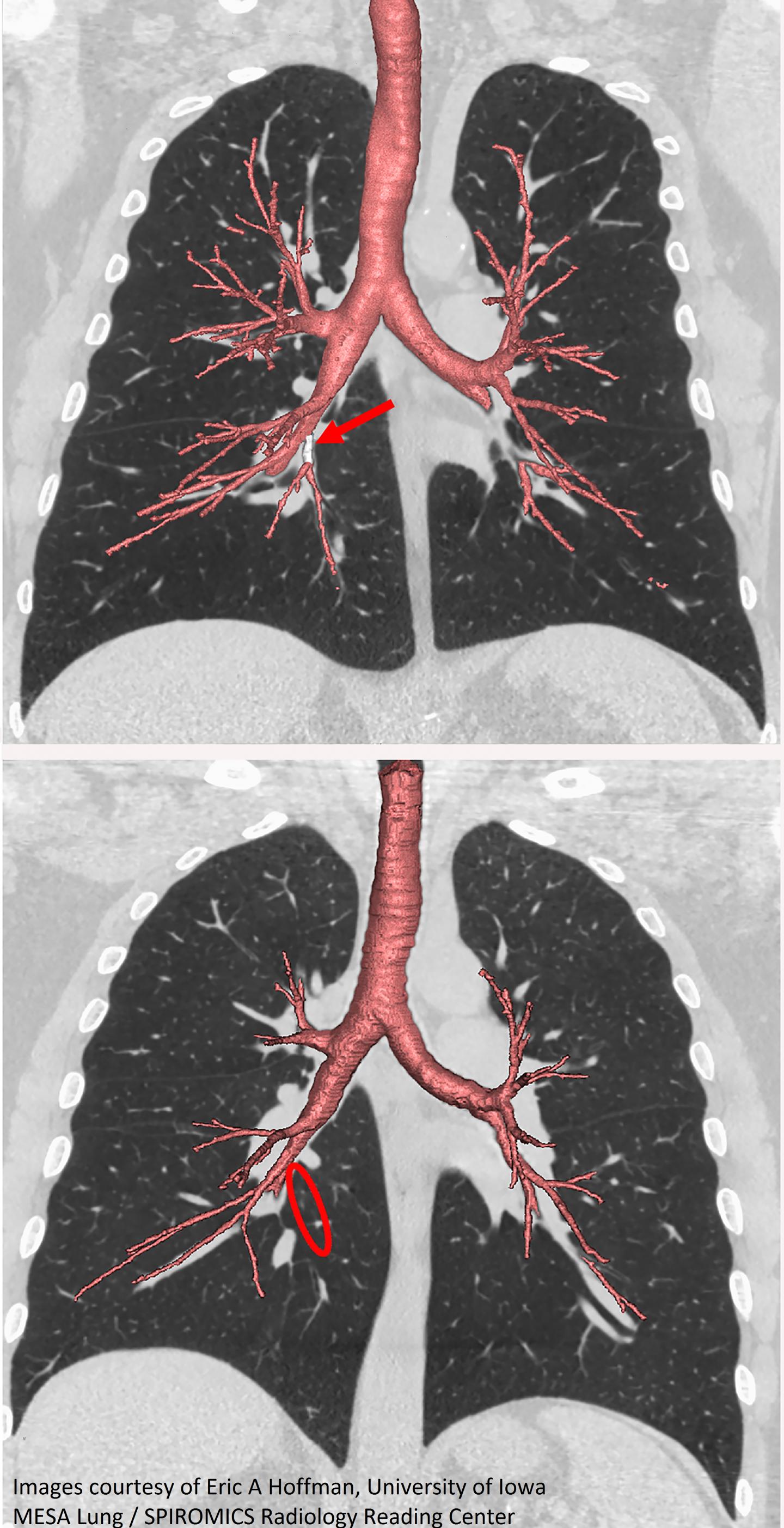 Images of the Lungs Highlighting the Airway Branches
