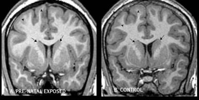 MRI Brain Images -- Exposed vs. Control
