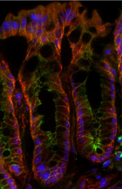 APC Ceta Catenin Colon