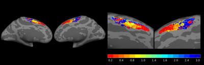 Activation Maps in the Supplementary Motor Area of the Two Cerebral Hemispheres