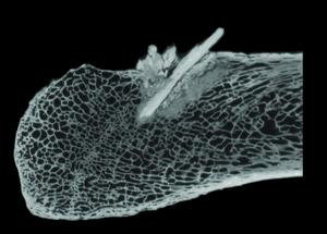 CT scan of embedded bone point