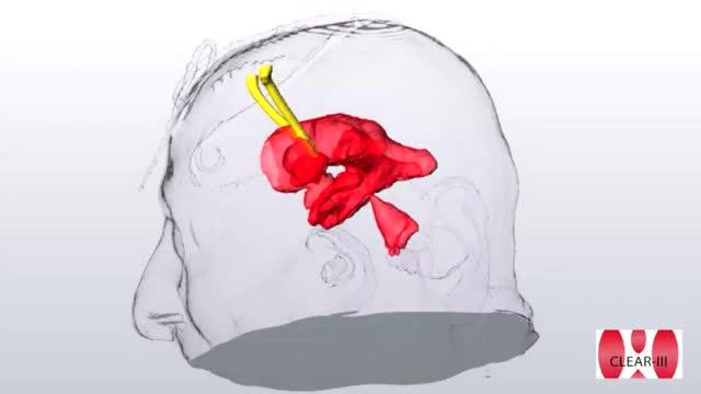 3-D Rendering of Intraventricular Blood Removal