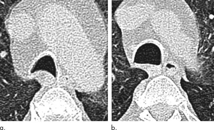 Weight Loss Surgery Improves Breathing Issues in Obese Patients