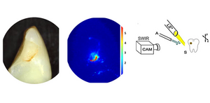 When combined with air drying, shortwave-infrared can be used to detect active dental cavities.