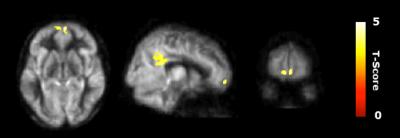 Cerebral Blood Flow -- Frontiers Aging Neuroscience