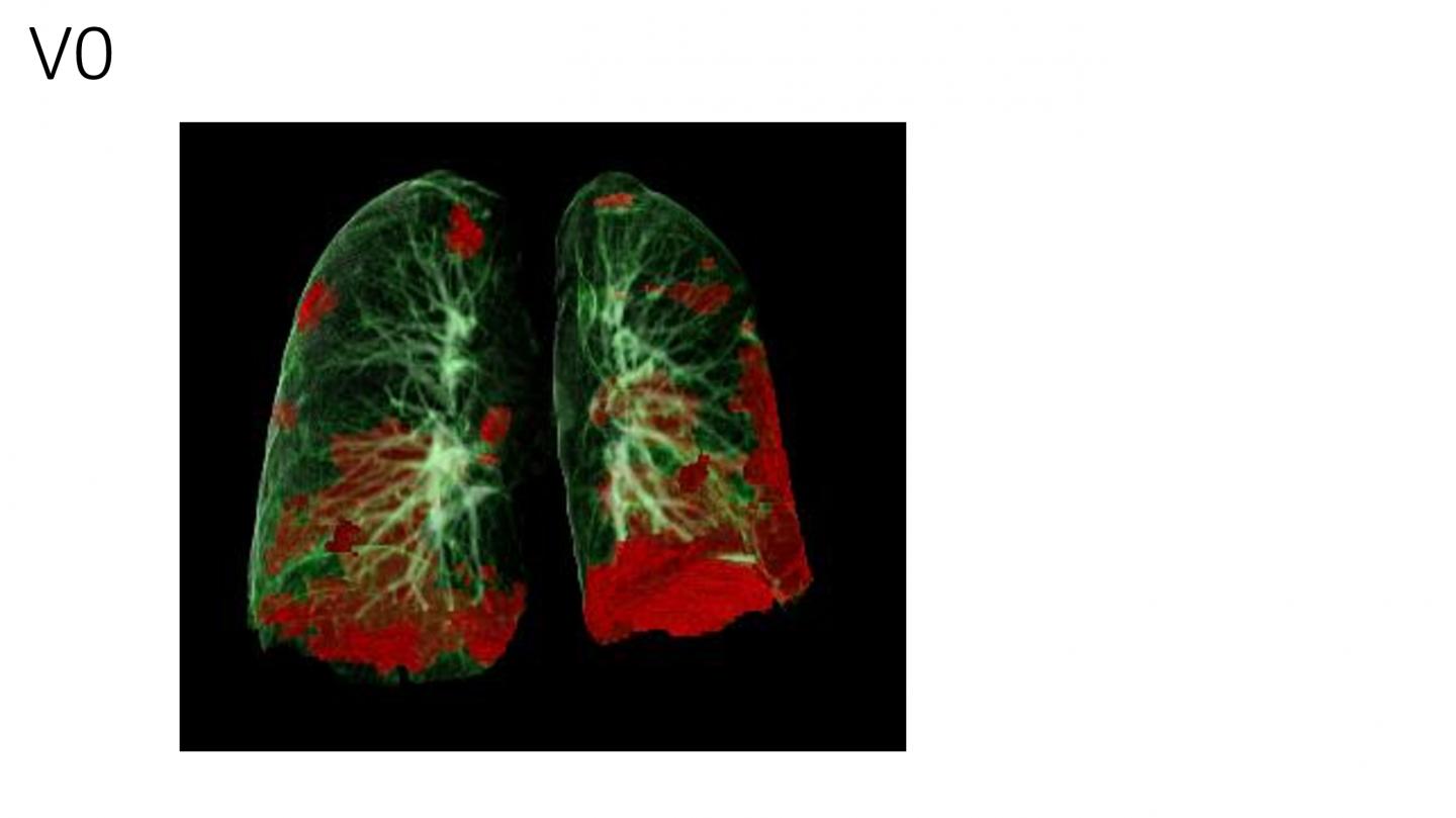 COVID-19 patients suffer long-term lung and heart damage