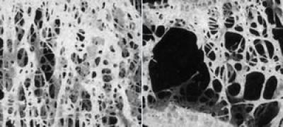 Osteoporosis (2 of 2)