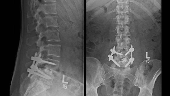 X-Ray of a Spinal Fusion